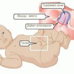 пупкова грижа у немовляти