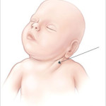 Кривошея у немовлят: причини і методи лікування (масаж\гімнастика)